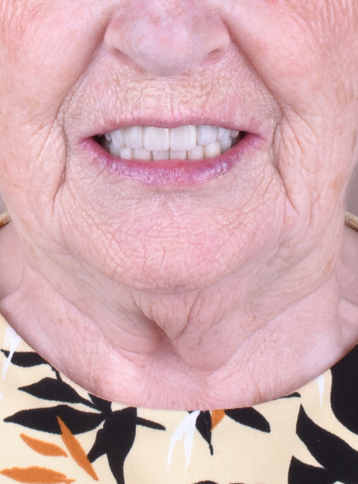 Resultado dental después del tratamiento en Institut Serra